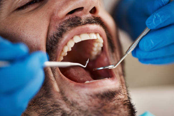 Best Emergency Treatment for Dental Infections or Abscesses in Sonora, TX